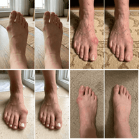 Thumbnail for Avenelle™ Foot Corrector – Restore Natural Toe Alignment at Home